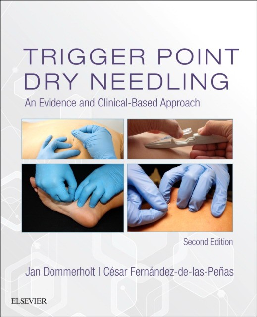 Trigger point dry needling