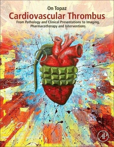 Cardiovascular Thrombus Cardiovascular Thrombus