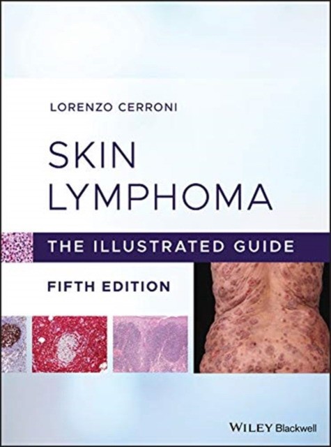 Skin lymphoma