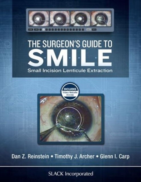 The Surgeon's Guide to SMILE: Small Incision Lenticule Extraction