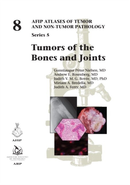 Tumors of the bones and joints