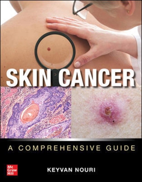 Skin Cancer: A Comprehensive Guide