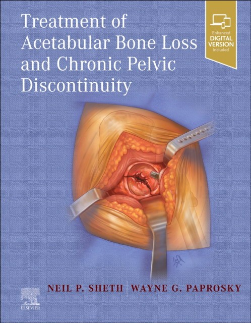 Treatment of acetabular bone loss and chronic pelvic discontinuity
