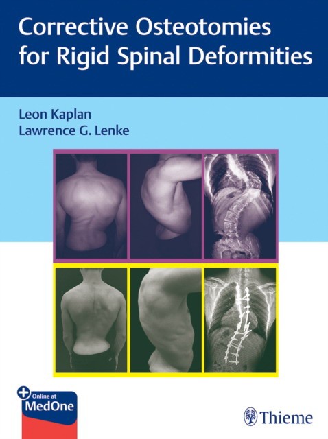 Rigid Spine Deformities