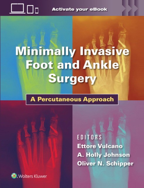 Minimally Invasive Surgery in Foot and Ankle: A Percutaneous Approach