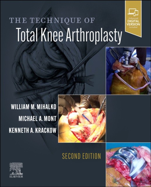 Technique of total knee arthroplasty