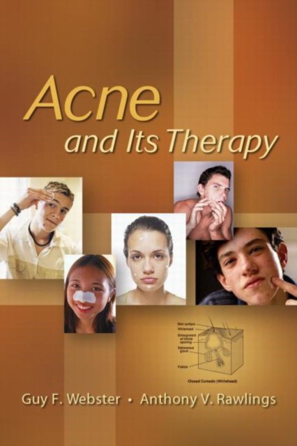 Acne And Its Therapy Acne And Its Therapy