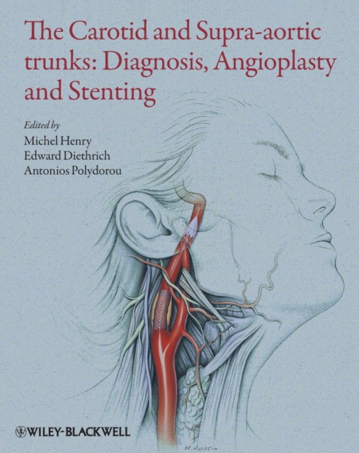 The Carotid and Supra-Aortic Trunks: Diagnosis, Angioplasty and Stenting, 2E The Carotid and Supra-Aortic Trunks: Diagnosis, Angioplasty and Stenting, 2E