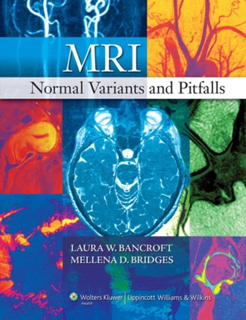 MRI Normal Variants and Pitfalls MRI Normal Variants and Pitfalls