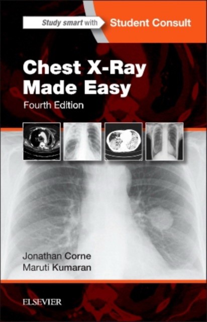 Chest X-Ray Made Easy. -Elsevier Science