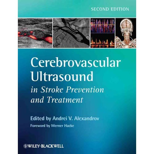 Cerebrovascular Ultrasound in Stroke Prevention and Treatment