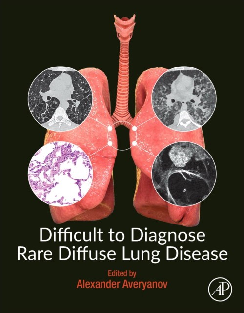 Difficult To Diagnose Rare Diffuse Lung Disease
